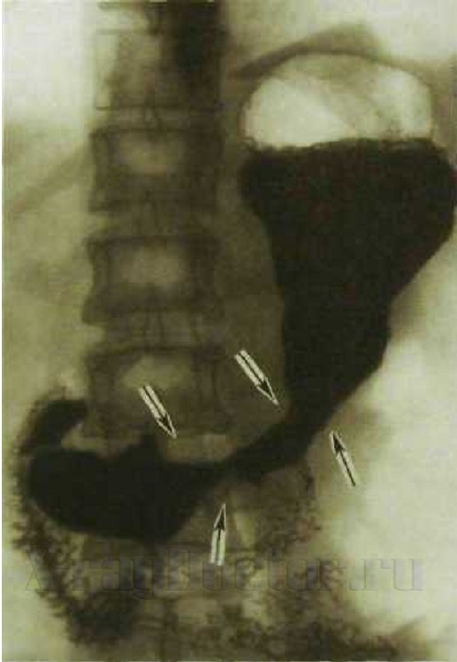 рентгенография желудка и двенадцатиперстной кишки при раке